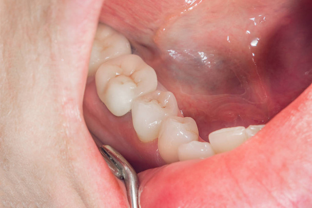 zubní plomba shnilé kořeny zubů s Keramické korunky. obsazení příspěvky stomatologie - Fotografie, Obrázek