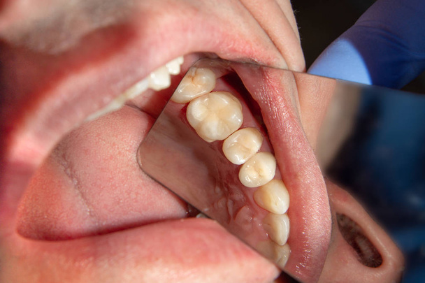 Hammashoito hammashoitolassa. Surkea karkea hammas lähikuva makro. Endodonttisten kanavien hoito
 - Valokuva, kuva