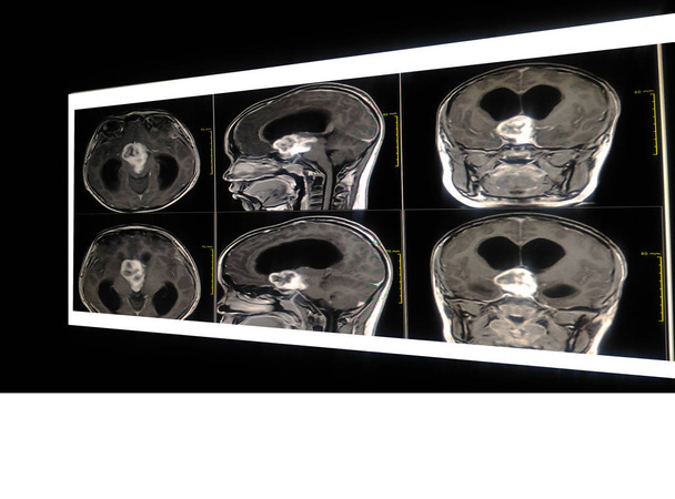 MRI mózgu i orbity 10-letni chłopiec. Wyświetlono a3.5cm. suprasellar masy przyczyna masowego efekt światłowodowe chiasm, trzeciej komory, przysadki mózgowej, podwzgórza. Obraz zbyt rozmazane i drak. - Zdjęcie, obraz