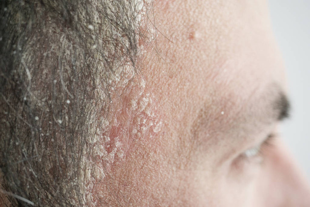 psoriasis on the hairline and on the scalp-close up, dermatological diseases, skin problems. - Photo, Image
