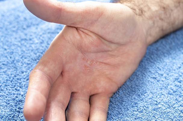 Peau dure et fissurée à l'intérieur de la main masculine. Maladie du psoriasis sur la main de l'homme
. - Photo, image