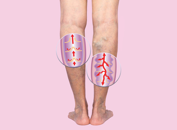 Spataderen op een vrouwelijke bejaarde benen. De structuur van normale en spataderen. - Foto, afbeelding