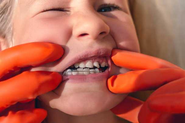 De arts probeert te zien van de monding van een klein meisje met een orthodontische toestel en kromme tanden. Wiebelig tand - Foto, afbeelding