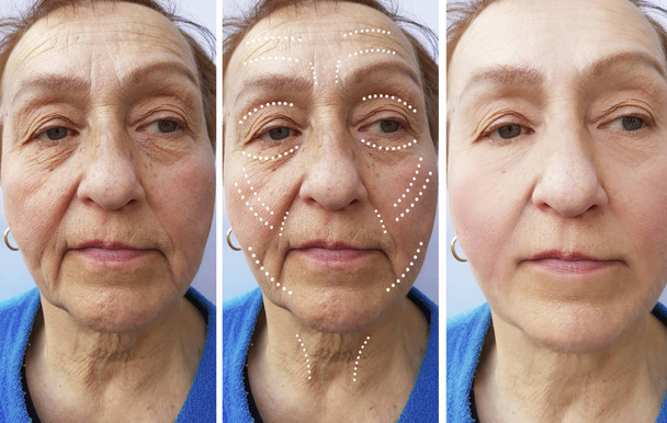 Stara kobieta zmarszczki przed i po zabiegach - Zdjęcie, obraz