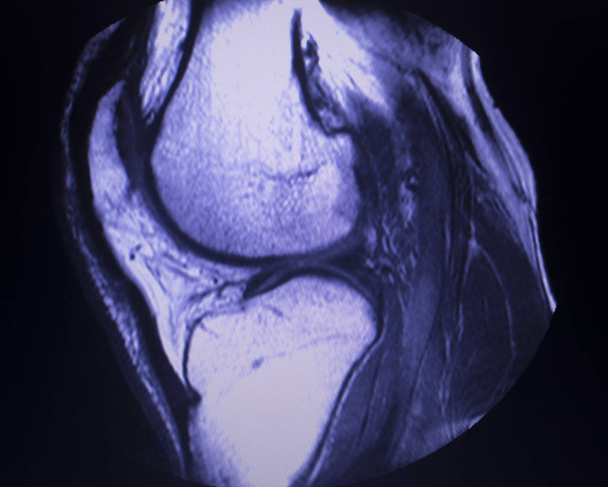 Magnetresonanztomographie mri knee posterior horn medial meniscus tear scantest results. - Foto, Bild