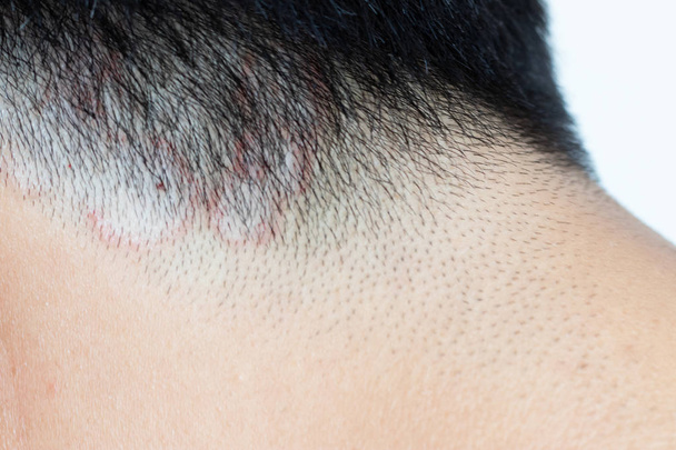 Zavřený kožního onemocnění (tinea) na hlavu asijských člověka (dermatitida) - Fotografie, Obrázek