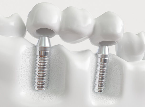 Implantes com ponte dentária - - renderização 3d
 - Foto, Imagem