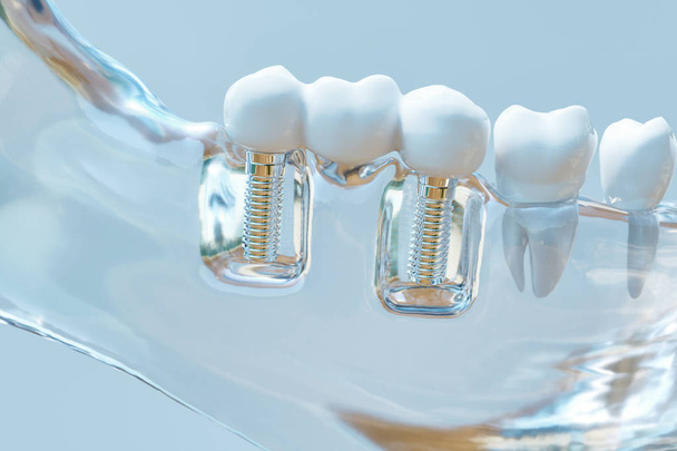 Diş insan implant--3d render - Fotoğraf, Görsel