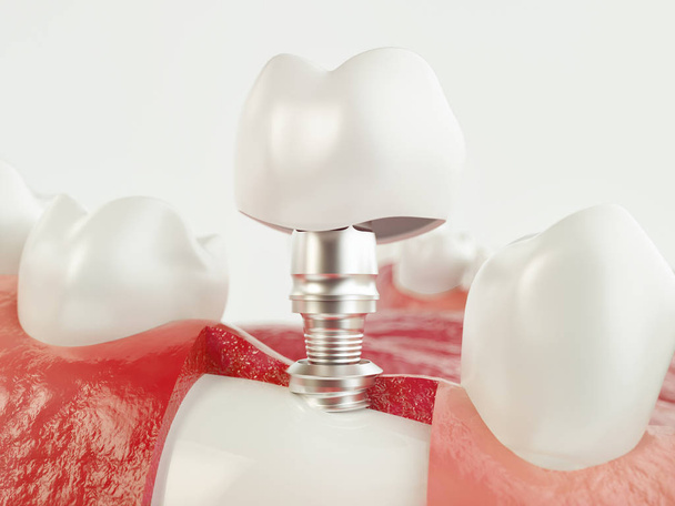 İnsan implant diş. Diş kavramı. İnsan diş ya da protez. 3D render - Fotoğraf, Görsel