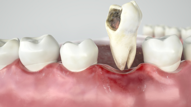 Τερηδόνα σε τρία στάδια - στάδιο 3 δόντι εκχύλιση--3d Rendering - Φωτογραφία, εικόνα