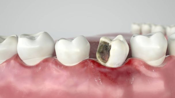 Caries in three stages - Stage 2 strong caries attack -- 3D Rendering - Photo, Image