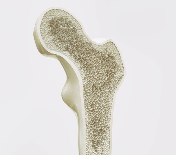 Osteoporose estágio 2 de 4 - renderização 3d - Foto, Imagem