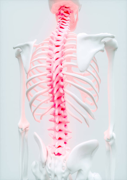 Остеопороз 4-й стадии из 4 - кости верхней подвздошной кости - 3D-рендеринг - Фото, изображение