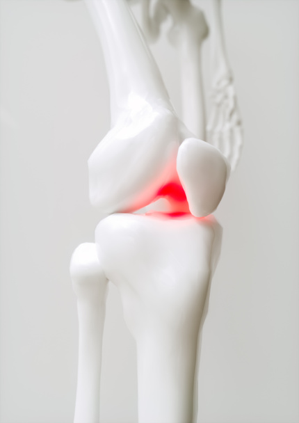 Osteoarthritis-covered knee --- 3D Rendering - Valokuva, kuva