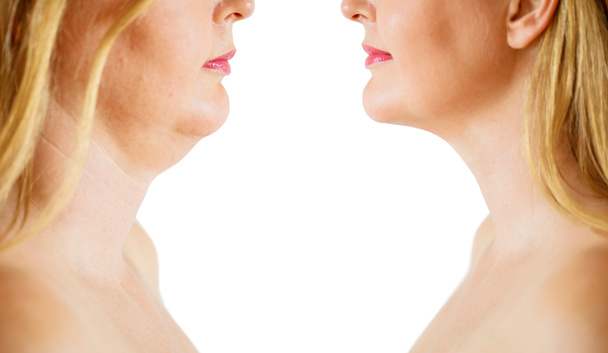 Double chin fat or dewlap correction, before and after - Photo, Image