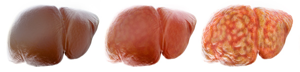 脂肪肝の現実的な段階-- 3Dレンダリング - 写真・画像