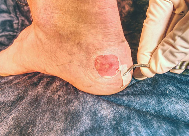 Mediciman treat damaged skin on sportsman heel.  Nasty hot place of damaged skin near Achilles tendon - Photo, Image