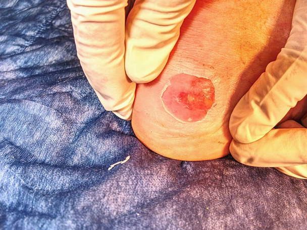Detail van een verse bloedige blaar op de been na sport ongeval. Warm en onaantastbaar plaats op mannelijke huid.  - Foto, afbeelding