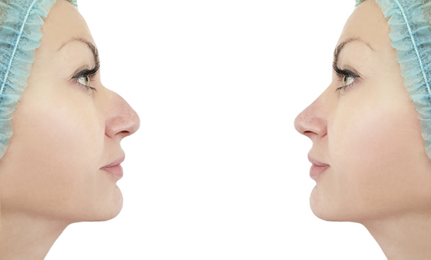 vrouw neuscorrectie vóór en na de procedures - Foto, afbeelding