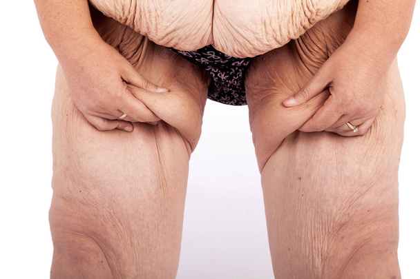 中年赤ちゃんや極端な体重減少後の皮膚のたるみを持つ女性。ポスターとミームの前にオーストラリアで brachioplasty、脂肪層切除、腹部およびミイラの変身のためのインスピレーション. - 写真・画像