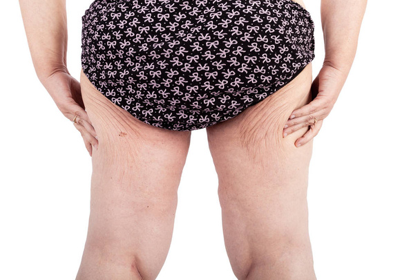 中年赤ちゃんや極端な体重減少後の皮膚のたるみを持つ女性。ポスターとミームの前にオーストラリアで brachioplasty、脂肪層切除、腹部およびミイラの変身のためのインスピレーション. - 写真・画像