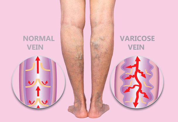 Venas varicosas en las piernas de una mujer mayor. La estructura de las venas normales y varicosas. - Foto, Imagen