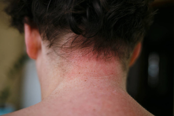 Skin Allergy Symptoms of patient, Allergic skin reaction on the female neck and chest. Health problem. Psoriasis skin - 写真・画像