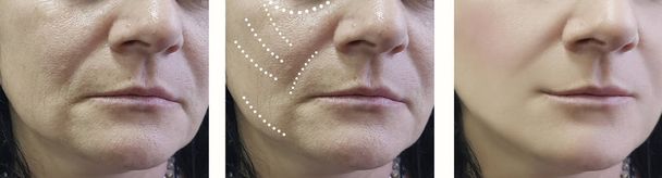 arrugas de mujer antes y después de los tratamientos
 - Foto, Imagen