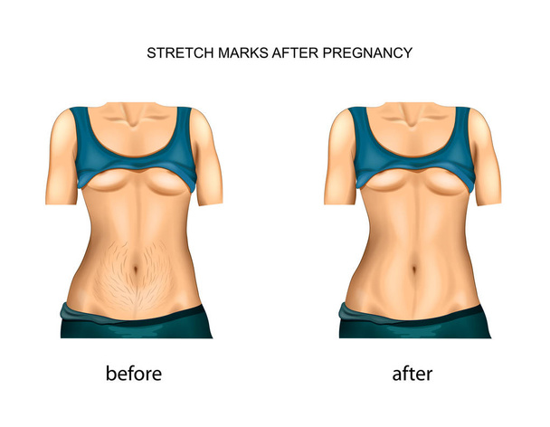 Vector εικονογράφηση ραγάδες μετά την εγκυμοσύνη. πριν και μετά. - Διάνυσμα, εικόνα
