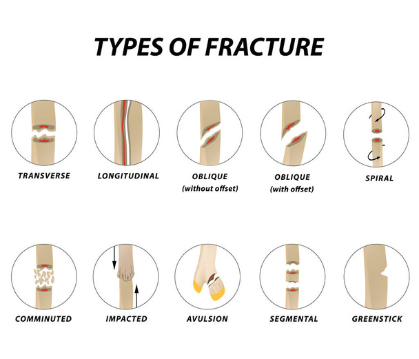 Tipos de fractura. Conjunto óseo de fractura. Infografías. Ilustración vectorial sobre fondo aislado - Vector, imagen