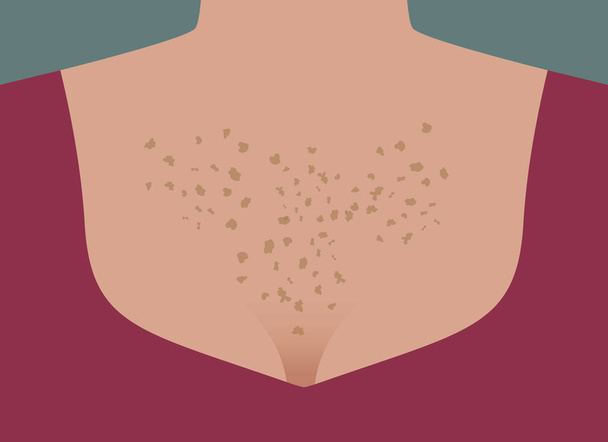 freckles on chest - Vector, Image
