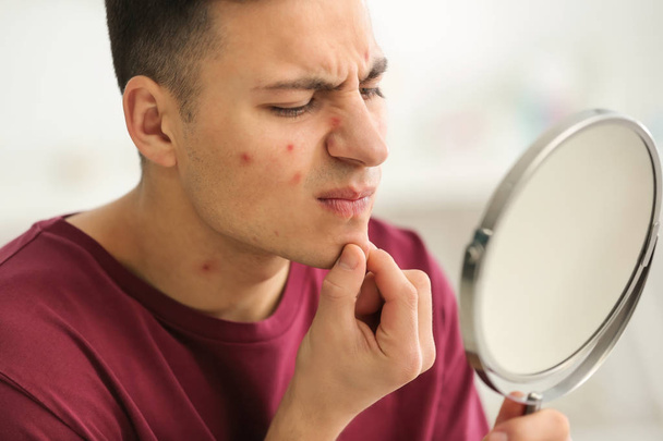 Retrato de un joven con problemas de acné mirándose en el espejo en casa
 - Foto, imagen
