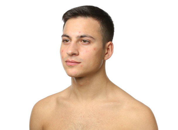 Портрет молодого чоловіка з проблемою акне на білому тлі
 - Фото, зображення