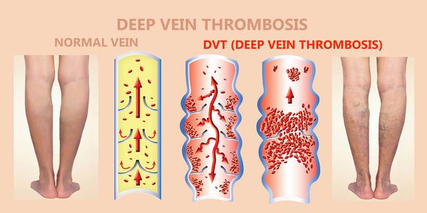 Deep Vein Thrombosis or Blood Clots. Embolus. - Photo, Image