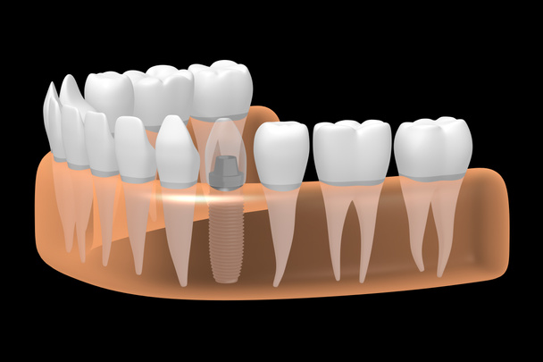 Diş implantı / implant diş - Fotoğraf, Görsel