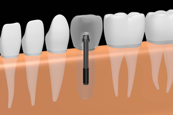 Implante dental / implante dental
 - Foto, imagen