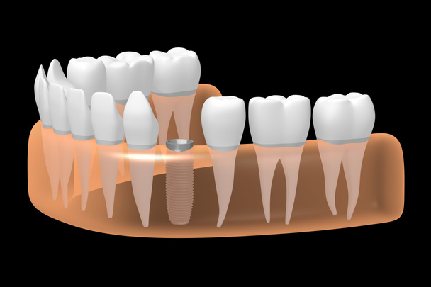 Dental implant / ząb implantu - Zdjęcie, obraz