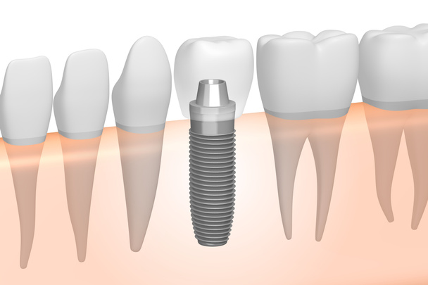 Implante dentário / implante dentário
 - Foto, Imagem