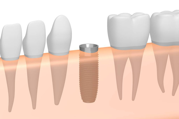 Implante dental / implante dental
 - Foto, imagen