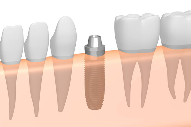 Dental implant / implantaat-tands - Foto, afbeelding