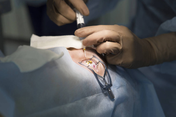 Λέιζερ χειρουργική επέμβαση για την αφαίρεση καταρράκτη και διόρθωση όρασης - Φωτογραφία, εικόνα