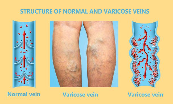 Veias varicosas em umas pernas seniores femininas. A estrutura das veias normais e varicosas. - Foto, Imagem
