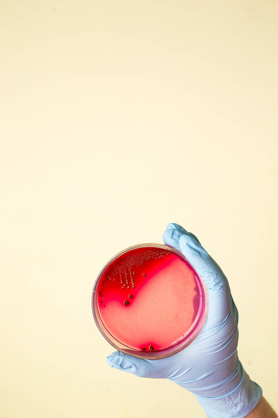 La mano sostiene la placa de Petri con bacterias Staphylococcus aureus. Análisis de laboratorio médico para la infección.Crecimiento del cultivo de colonias bacterianas en placa de agar en sangre, cultivo de cocos bacilos grampositivos, hemólisis beta
 - Foto, Imagen