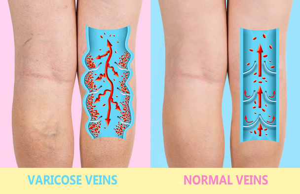 Venas varicosas en las piernas de una mujer mayor. La estructura de las venas normales y varicosas. - Foto, imagen