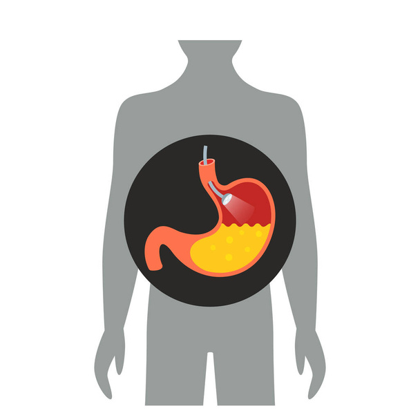 endoscope light on examination in the stomach. flat vector illustration - Vector, Image