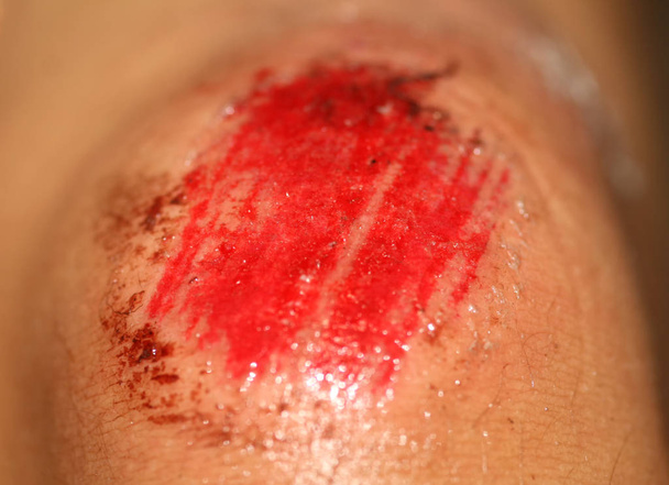 Die Wunde ist blutig am Knie. Verletzung des Knies - Foto, Bild