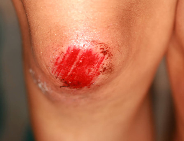 A ferida tem sangue no joelho. Lesão do joelho
 - Foto, Imagem