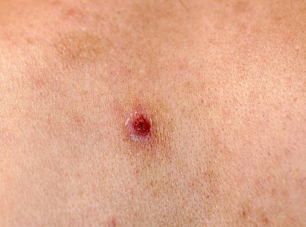 Torn off a bleeding pimple on the skin. Inflammation, acne. - Photo, Image