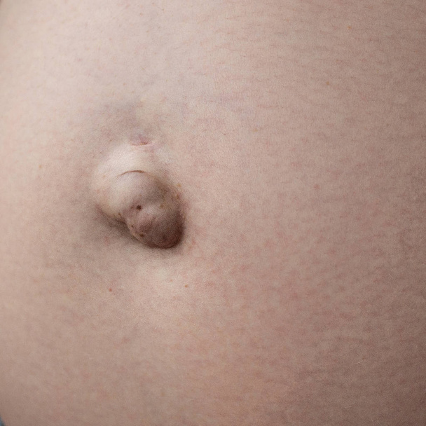 Hernia umbilical en una mujer embarazada. Primer plano.
 - Foto, Imagen