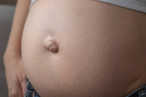 Hernia umbilical en una mujer embarazada. Primer plano.
 - Foto, Imagen